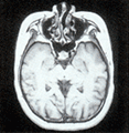 MRI